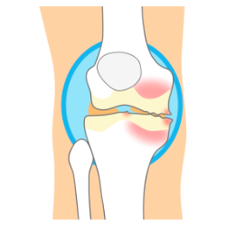 膝の痛みの画像